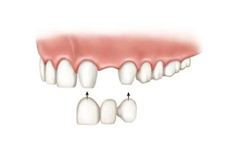 OPCIONES DE PUENTES DENTALES FIJOS Y PUENTES DENTALES REMOVIBLES ...