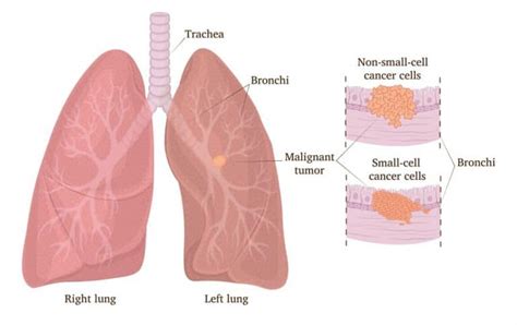 Understanding the EGFR mutation aids the fight against lung cancer ...