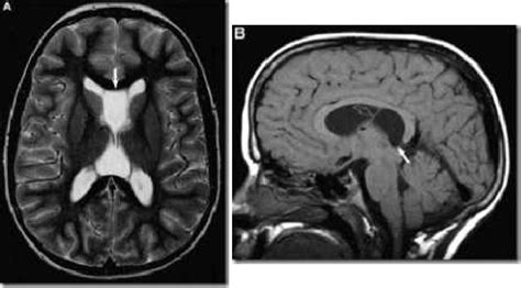 Figure 2 from Cavum septum pellucidum ( CSP ) , Cavum vergae and Cavum ...