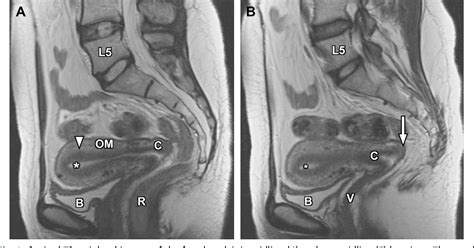 Figure 1 from Normal and variant pelvic anatomy on MRI. | Semantic Scholar