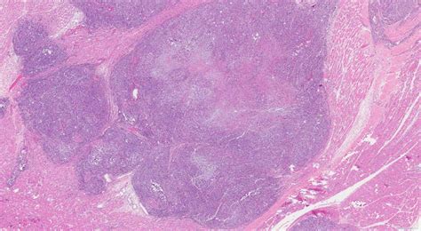 Epithelioid sarcoma | Ottawa Atlas of Pathology