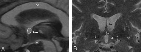 Anterior Commissure Mri