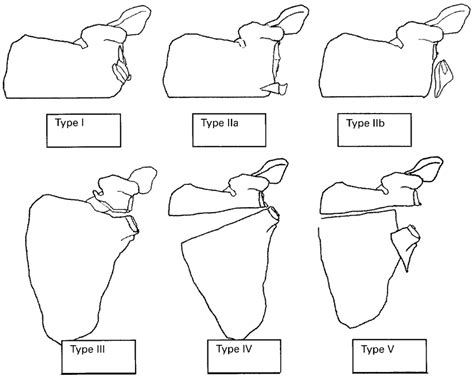 Glenoid Fracture Classification | My XXX Hot Girl