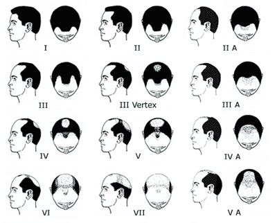 Male Pattern Baldness | MPB | Male Pattern Hair Loss | Alopecia | Baldness