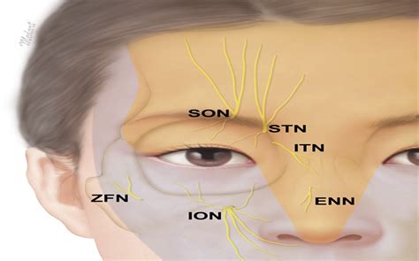 Emerging Points of the Supraorbital and Supratrochlear Nerve... : Dermatologic Surgery