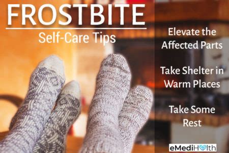 Frostbite Stages, Prevention and Treatment - eMediHealth