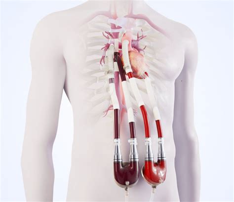 New circulation implant to bridge the waiting time for donor heart • healthcare-in-europe.com