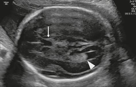 SciELO - Brasil - Ultrasonographic evaluation of the fetal central nervous system: review of ...