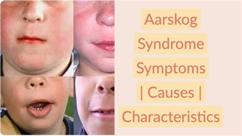 Aarskog Syndrome Symptoms | Causes | Characteristics - YouTube