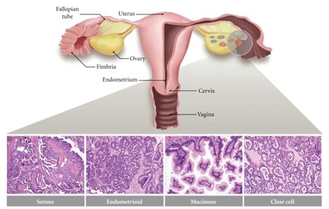 The major histologic subtypes of ovarian carcinoma. Serous carcinomas... | Download Scientific ...