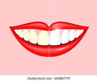 Smiling Unhealthy Mouth Healthy Smile Bleaching Stock Vector (Royalty Free) 602380403 | Shutterstock