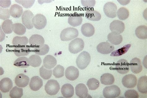 Free picture: thick, film, micrograph, mixed, falciparum, malariae, parasitic, infection