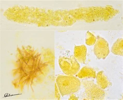 Collected urine samples with bilirubin crystals | Dr Roshan Nasimudeen posted on the topic ...