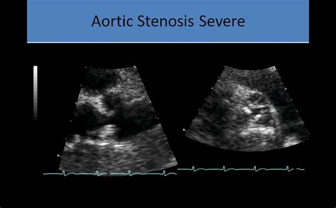 Aortic Stenosis Echo Doppler