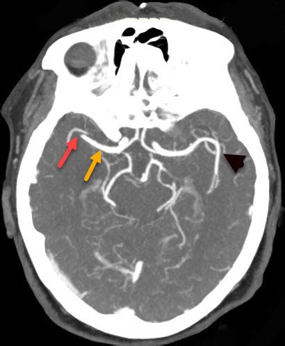 MCA occlusion stroke, MCA Segments Radiology | Radiology For Beginners