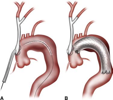 Use of custom Dacron branch grafts for “hybrid” aortic debranching ...