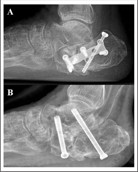 Rotational Osteotomy and Subtalar Arthrodesis for Subtalar Arthritis With Calcaneal Malunion: A ...