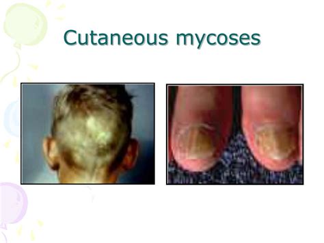 PPT - Superficial and Cutaneous Mycoses PowerPoint Presentation - ID:343517