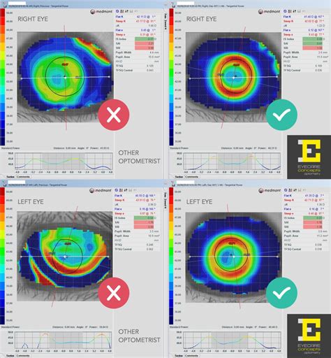 Ortho-K lenses not working? We can help - EYECARE CONCEPTS | MYOPIA ...