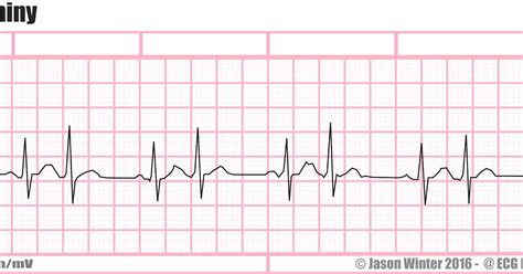 ECG Educator Blog : Atrial Bigeminy