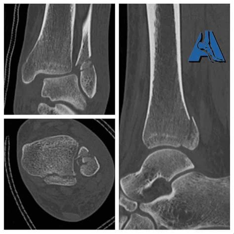 Bad Ankle Fracture - Tri-malleolar in Young Female Skateboarding ...