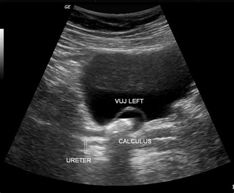 Ureterozele | pacs