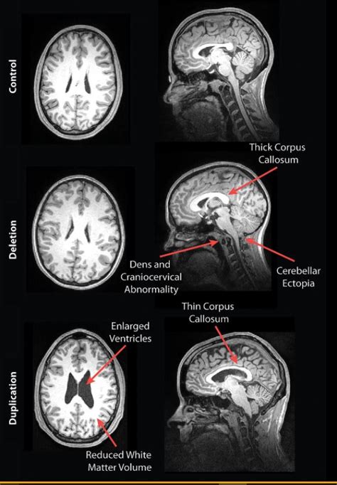 Epiphany: Autism MRI