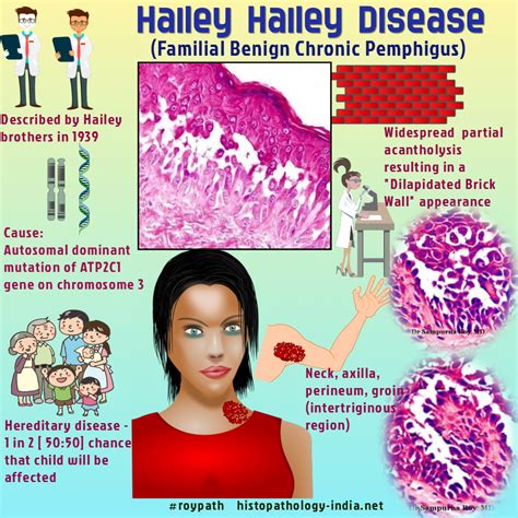 Hailey-Hailey disease | Hereditary diseases, Disease, Hailey