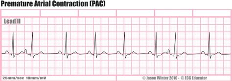 Premature Atrial Contractions - Boss RN