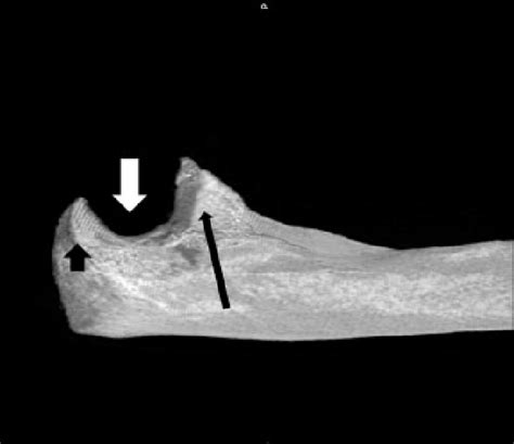 Normal anatomy of the elbow. The sigmoid notch (white arrow) is a... | Download Scientific Diagram