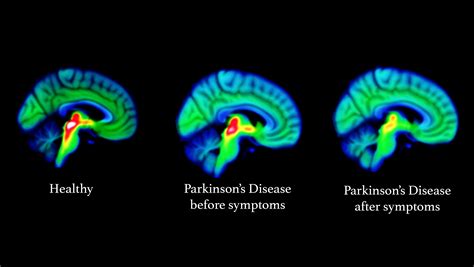 Earliest signs of Parkinson’s disease uncovered in brain, scientists say | Shropshire Star