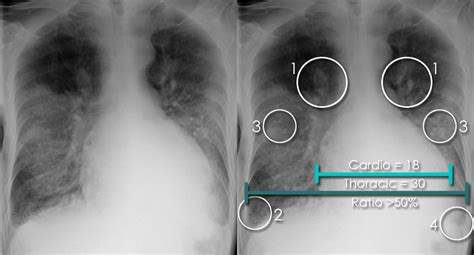 Pulmonary Edema X Ray Butterfly Pattern