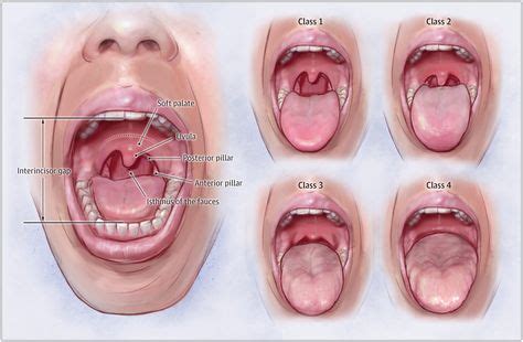 The Mallampati Score for Predicting Obstructive Sleep Apnea - Airway ...