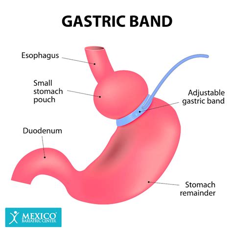 Lap Band Surgery Cost Mexico starting at $5,695 - Mexico Bariatric Center