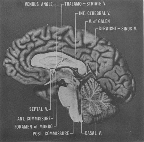 Identification of the anterior and posterior commissures by angiography ...