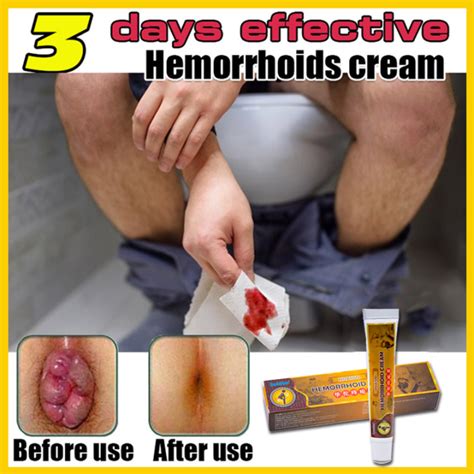 On Sale! Hemorrhoids Cream Original Gamot Sa Almoranas Ointment Original Hemmoriod Ointment ...