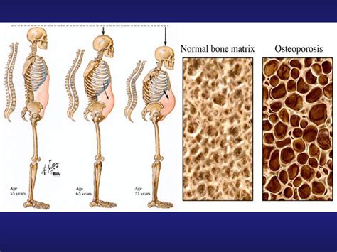 Bone density problems: Low Bone Density > Fact Sheets > Yale Medicine