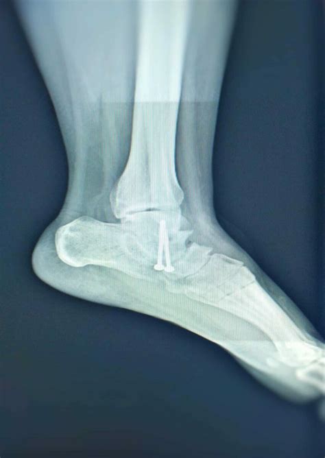 Subtalar Joint Arthritis: explained by a Foot Specialist