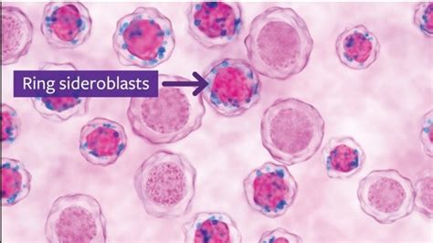 hematology different Flashcards | Quizlet