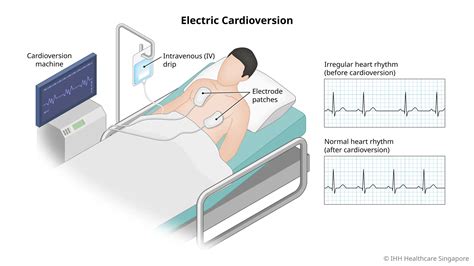 Cardioversion - For Abnormal Heart Rhythm | Gleneagles Hospital