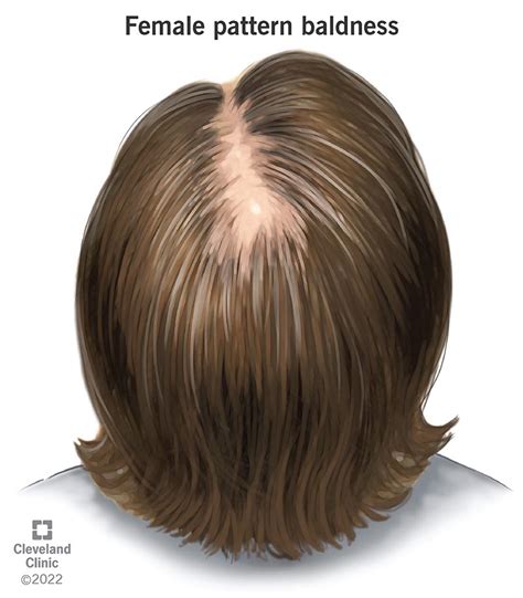 Female Pattern Baldness: Symptoms, Stages, Causes & Treatment, of female - plantecuador.com