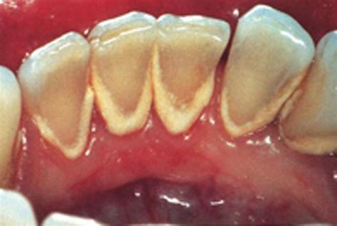 Dentistry lectures for MFDS/MJDF/NBDE/ORE: A NOTE ON DENTAL CALCULUS