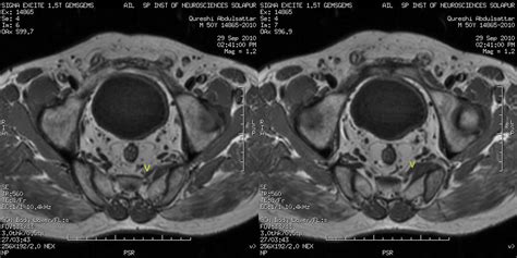 Dr Balaji Anvekar's Neuroradiology Cases: Pyriformis syndrome MRI