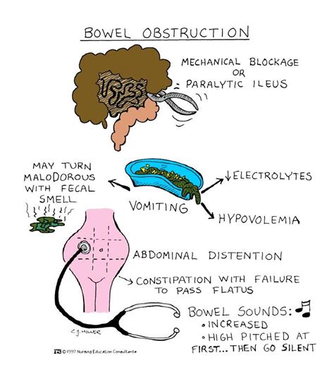 bowel obstruction | Pediatric nursing, Nursing study guide, Nursing ...