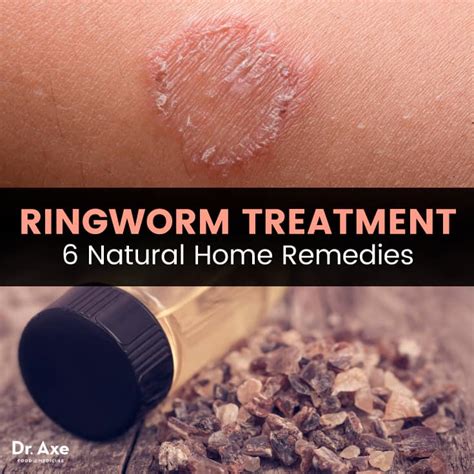 Ringworm is Not Caused by a Worm! Prevention and Natural Remedies for This Pesky Fungus