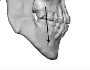 Plastic Surgery Case Study - Reshaping/Derotating The Steep Mandibular Plane Angle Lower Face ...