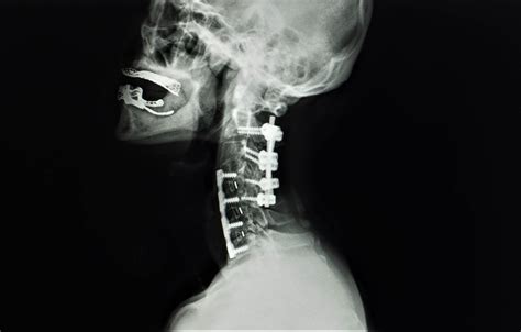 Cervical Discectomy And Fusion