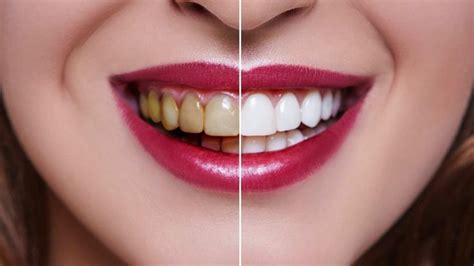 Teeth Whitening Near Me | Professional Teeth Whitening Houston ...