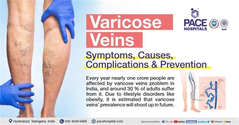 Varicose Veins – Symptoms, Causes, Complications and Treatment