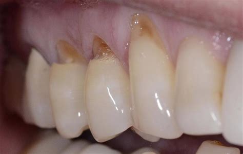 Before and After Tooth Colored Fillings | Alpharetta GA Dentist